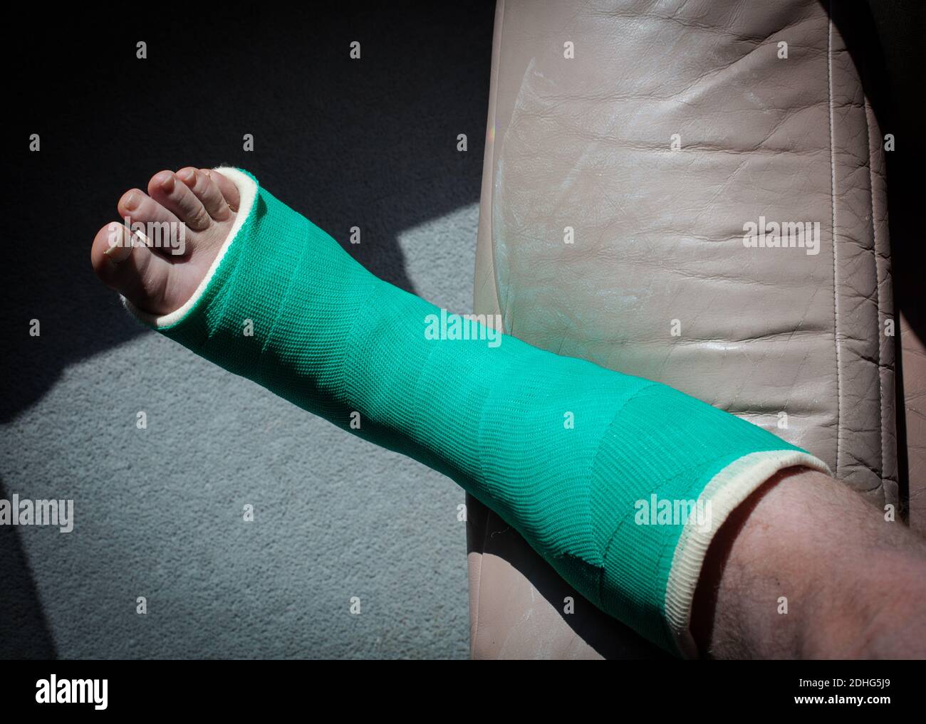 Broken ankle, in a fibreglass cast Stock Photo Alamy