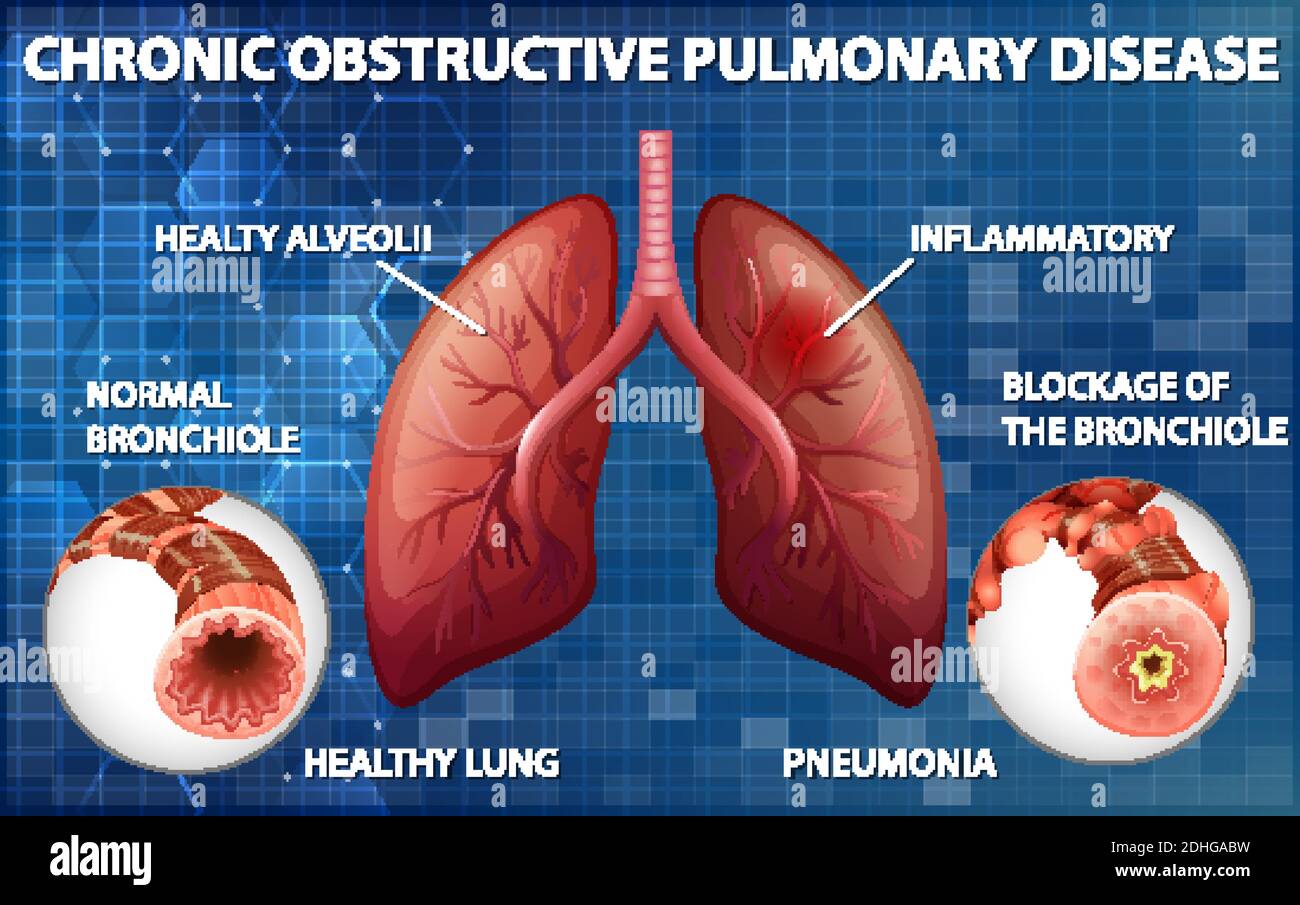 Chronic Obstructive Pulmonary Disease Illustration Stock Vector Image