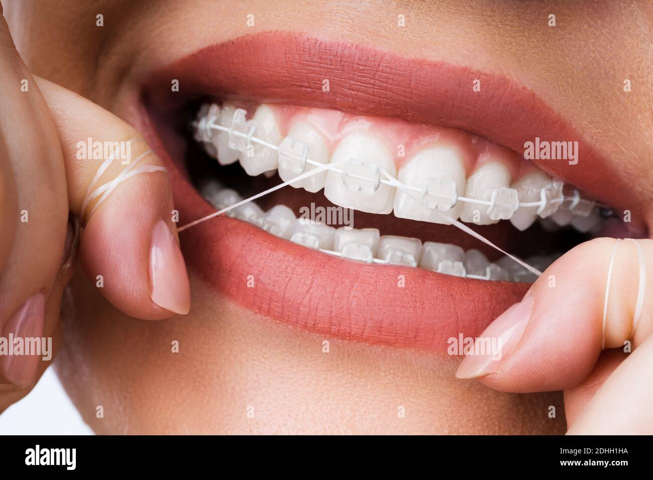 Female Cleaning Dental Brackets In Mouth Using Floss Stock Photo