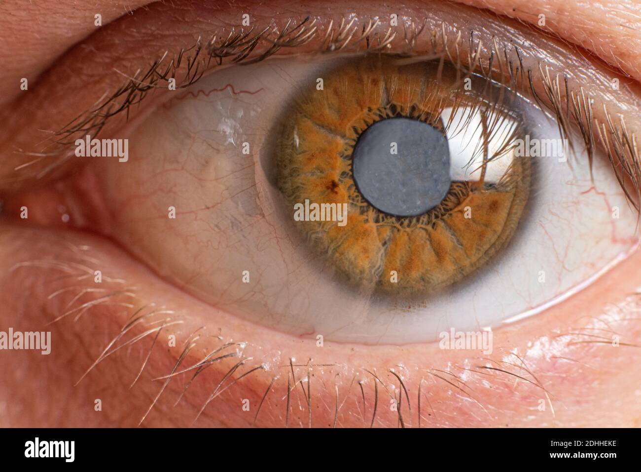 Macro photos of the human eye cataract clouding of the lens