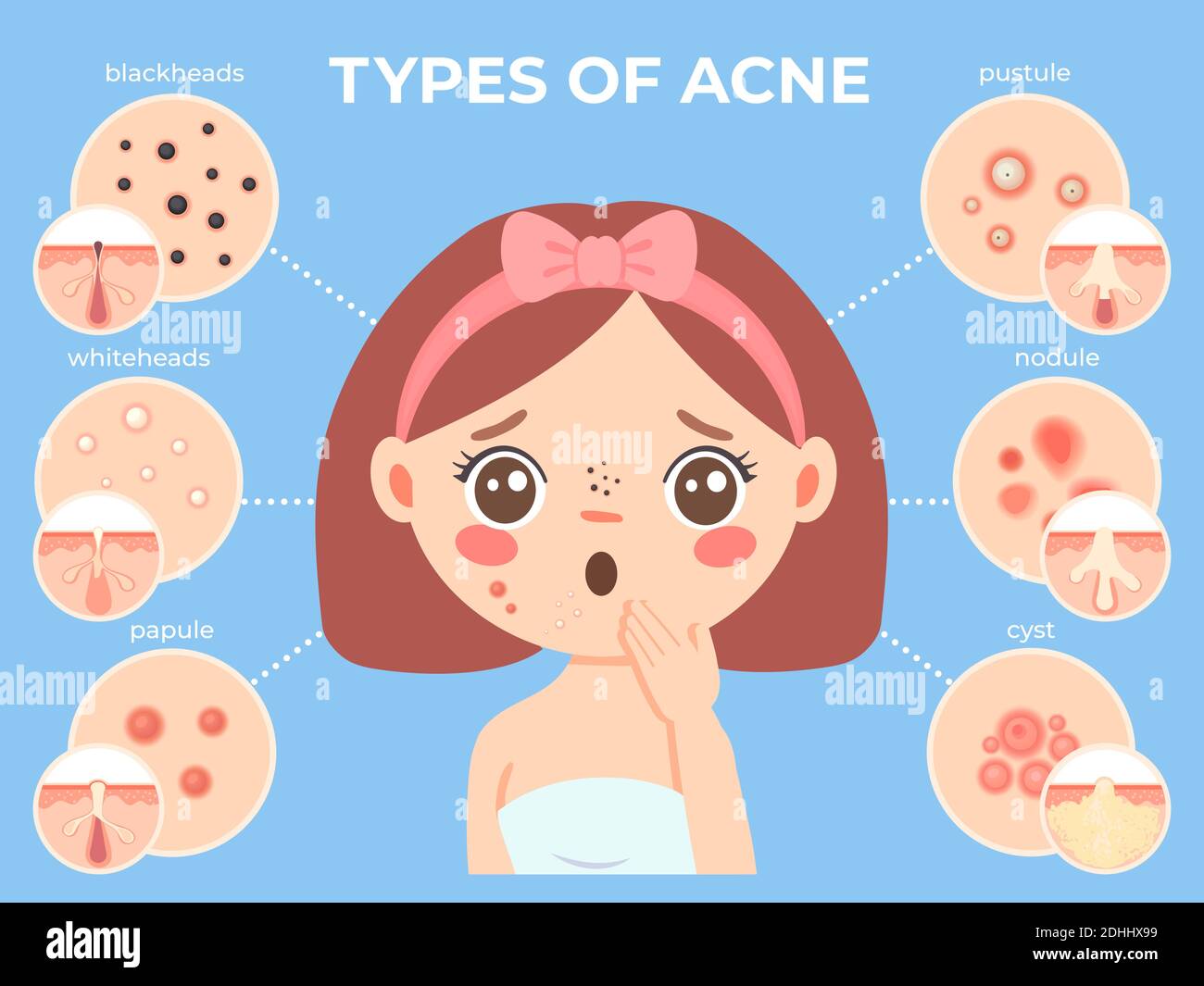 Girl with acne. Young unhappy female face with skin problems and pimple types icons. Dermatology and cosmetic skin care vector infographic Stock Vector
