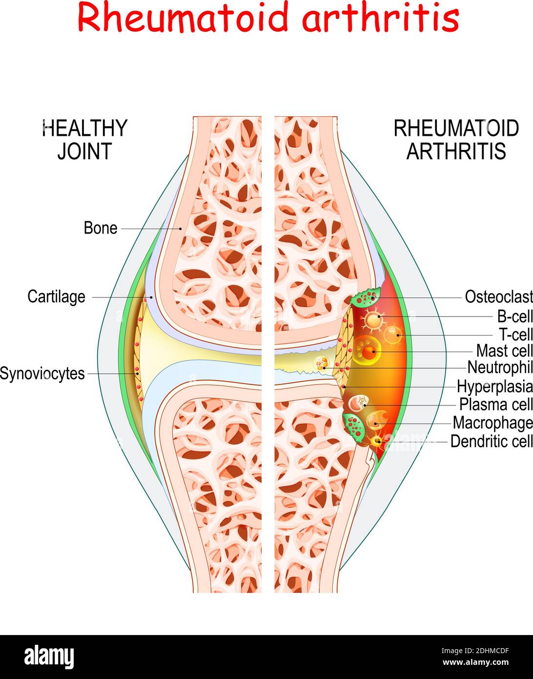 Rheumatoid arthritis. Healthy and damage joint. Close-up of bone, cartilage, and Cells in a joint capsule: synoviocytes, osteoclast, neutrophil Stock Vector