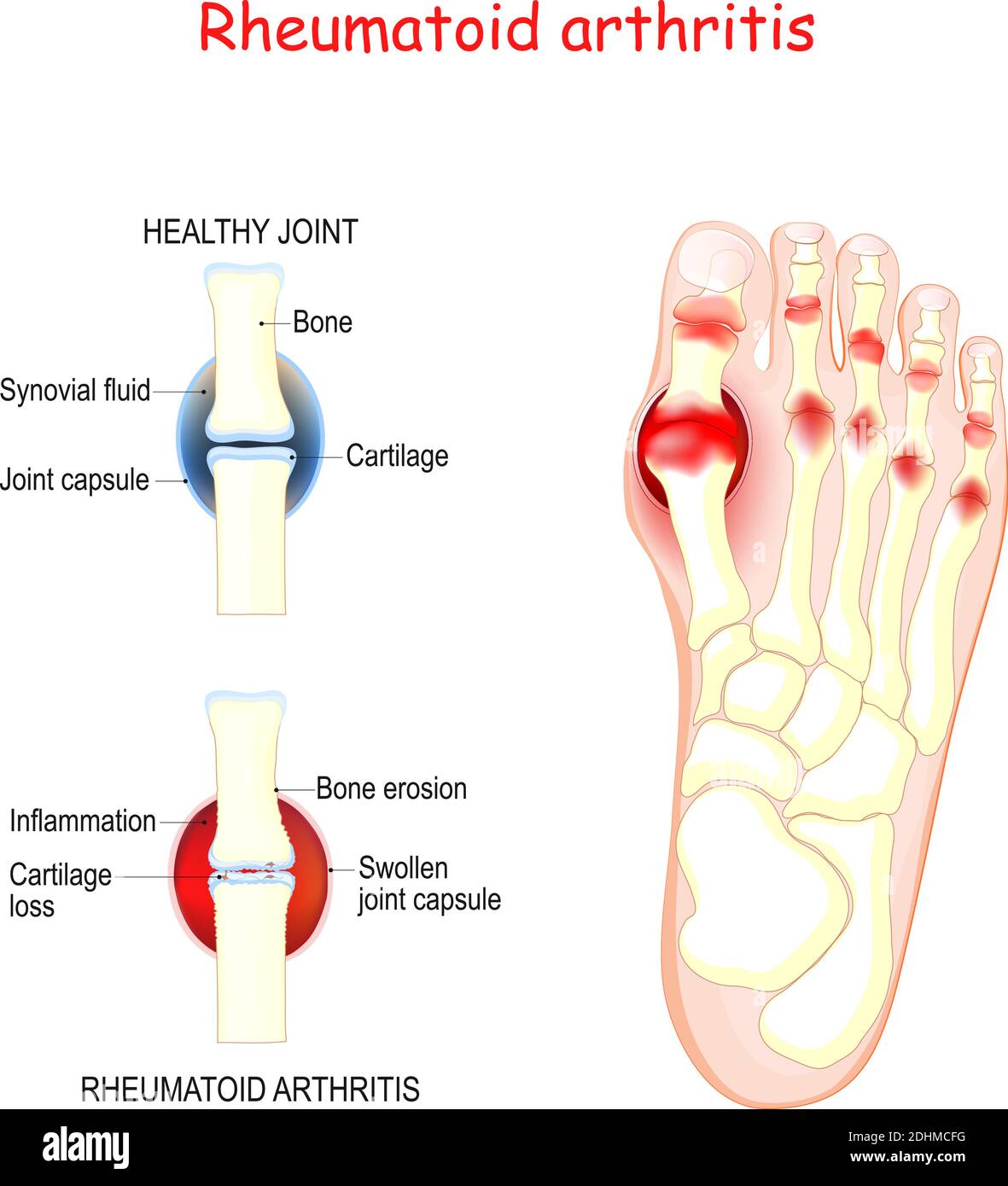 rheumatoid arthritis in joints of human's foot. comparison and