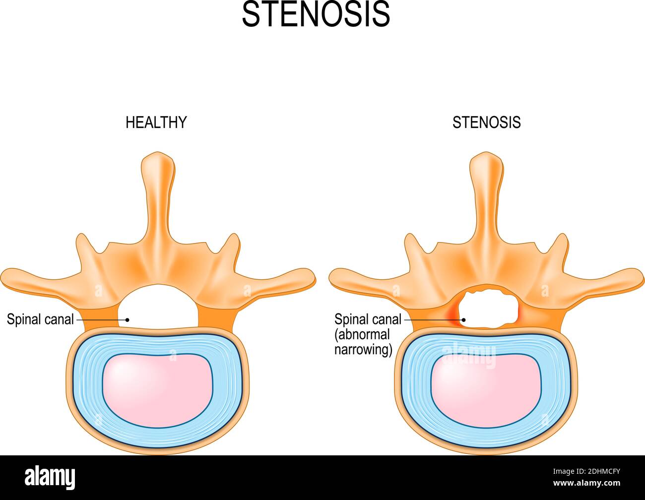 Lumbar Spinal Stenosis is an abnormal narrowing in spinal canal. section of the human vertebral column and cross-section of spinal cord. Vector Stock Vector