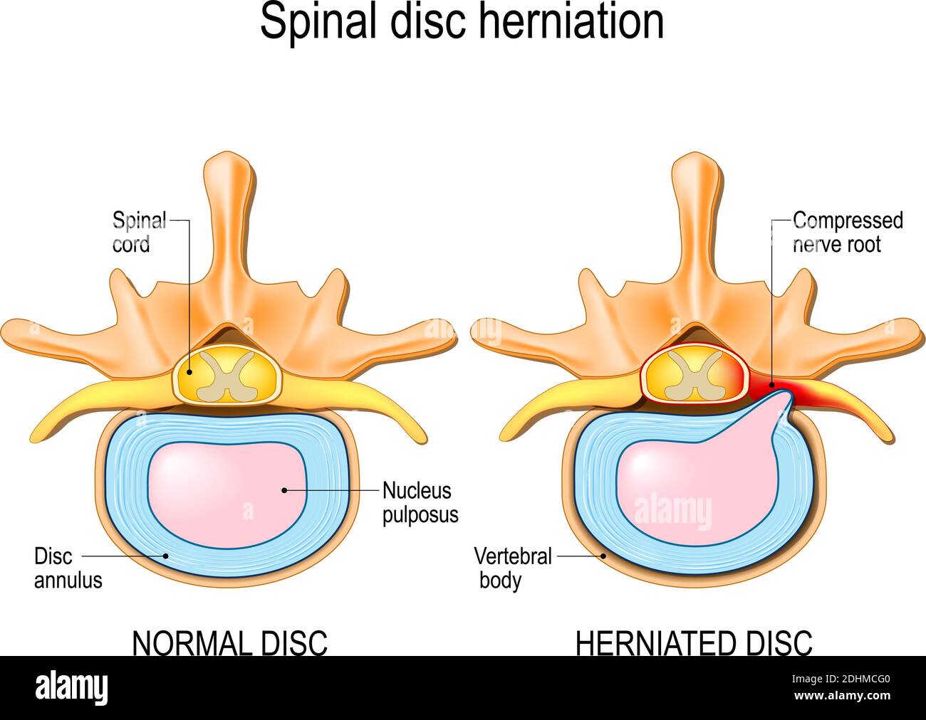 Spinal disc herniation. Back pain. Normal disc and spinal disc herniation in cervical vertebrae. Vector illustration Stock Vector