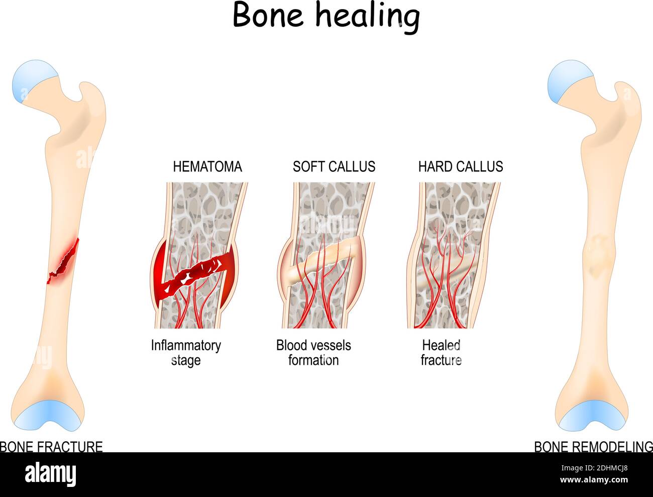 Bone healing Process after a bone fracture. Stages Of Bone Healing. Vector diagram Stock Vector