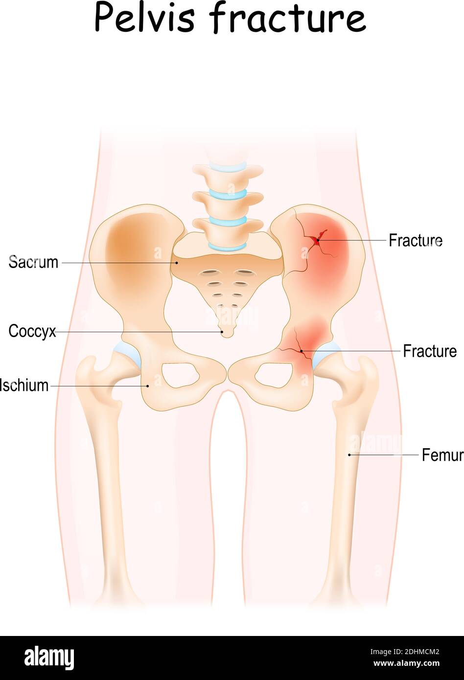 Pelvis Fracture. pelvic bones: sacrum, ilium, coccyx, pubis, ischium and femur. Vector illustration isolated on a white background Stock Vector