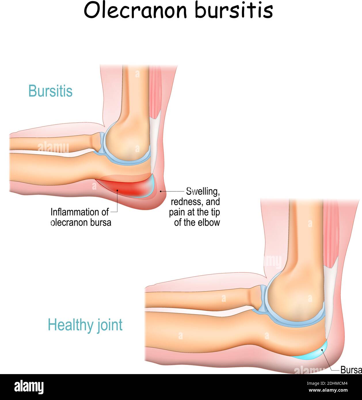 Olecranon bursitis. student elbow. medical condition. inflammation of the bursa located under the elbow Olecranon. trauma or repetitive smaller trauma Stock Vector