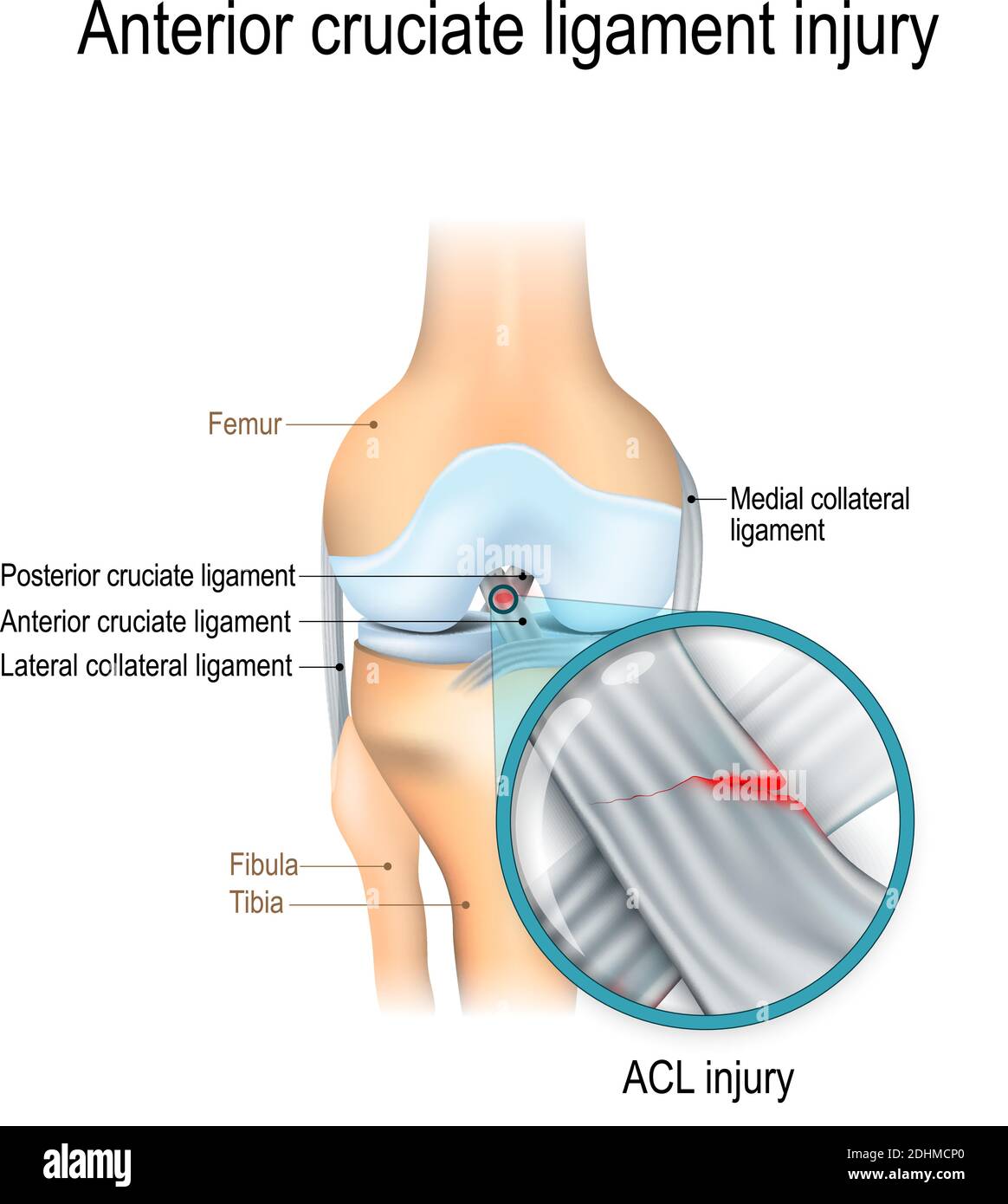 Anterior Cruciate Ligament Anatomy Stock Vector Images Alamy Anterior Cruciate Ligament Anatomy Stock Vector Images Alamy