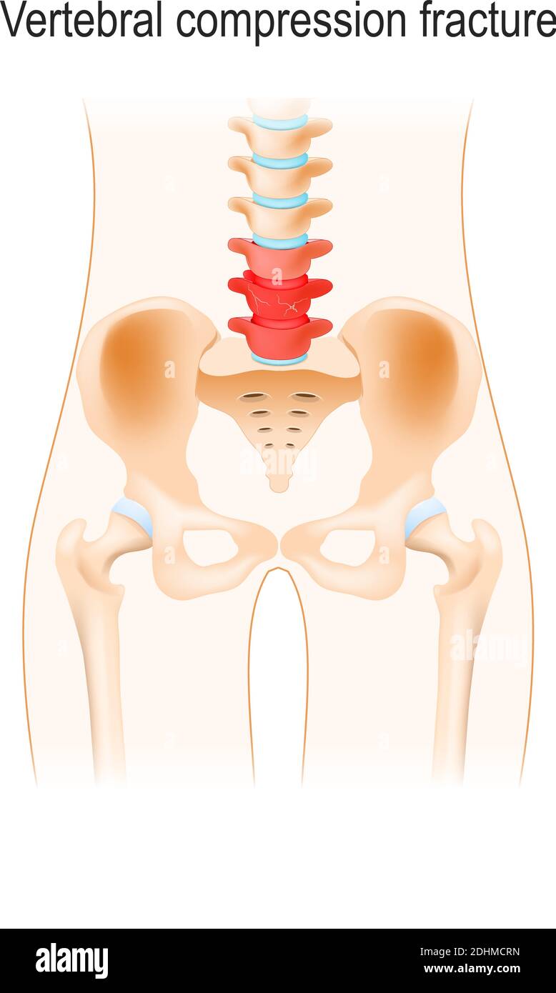 Vertebral compression fracture. Back pain. Human silhouette with ...