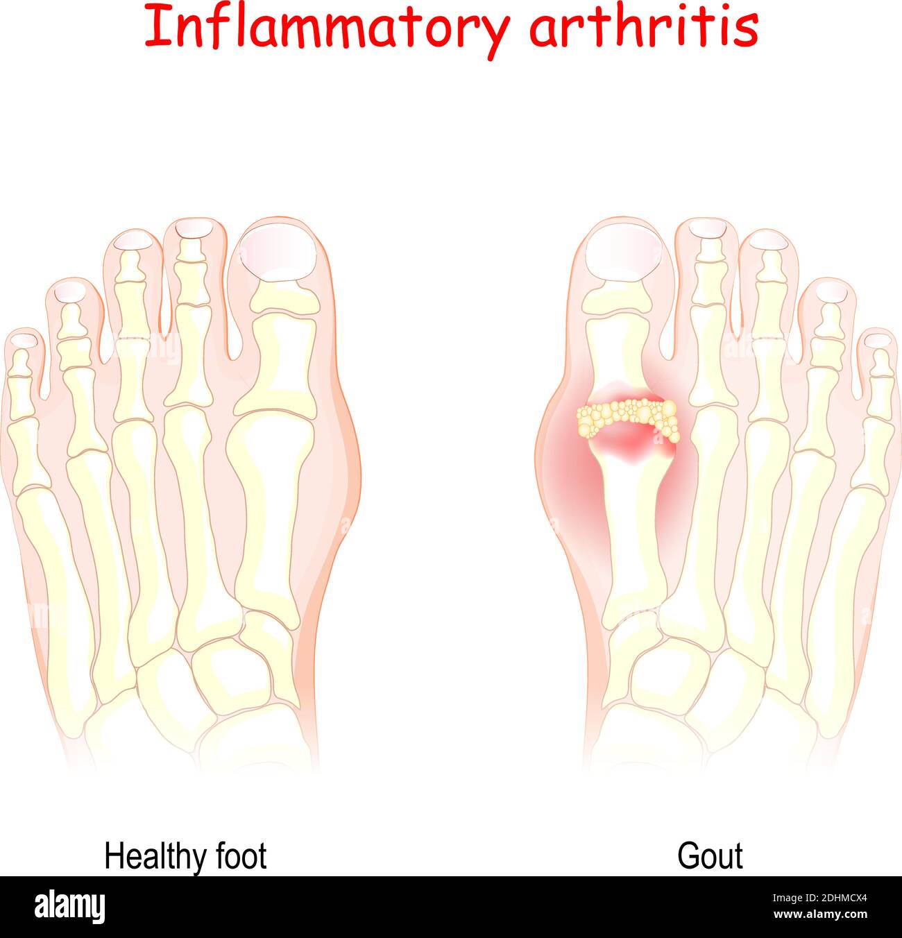 Gout. inflammatory arthritis. Vector Diagram of healthy foot and foot with gout. uric acid crystallizes and the crystals deposit in joints Stock Vector