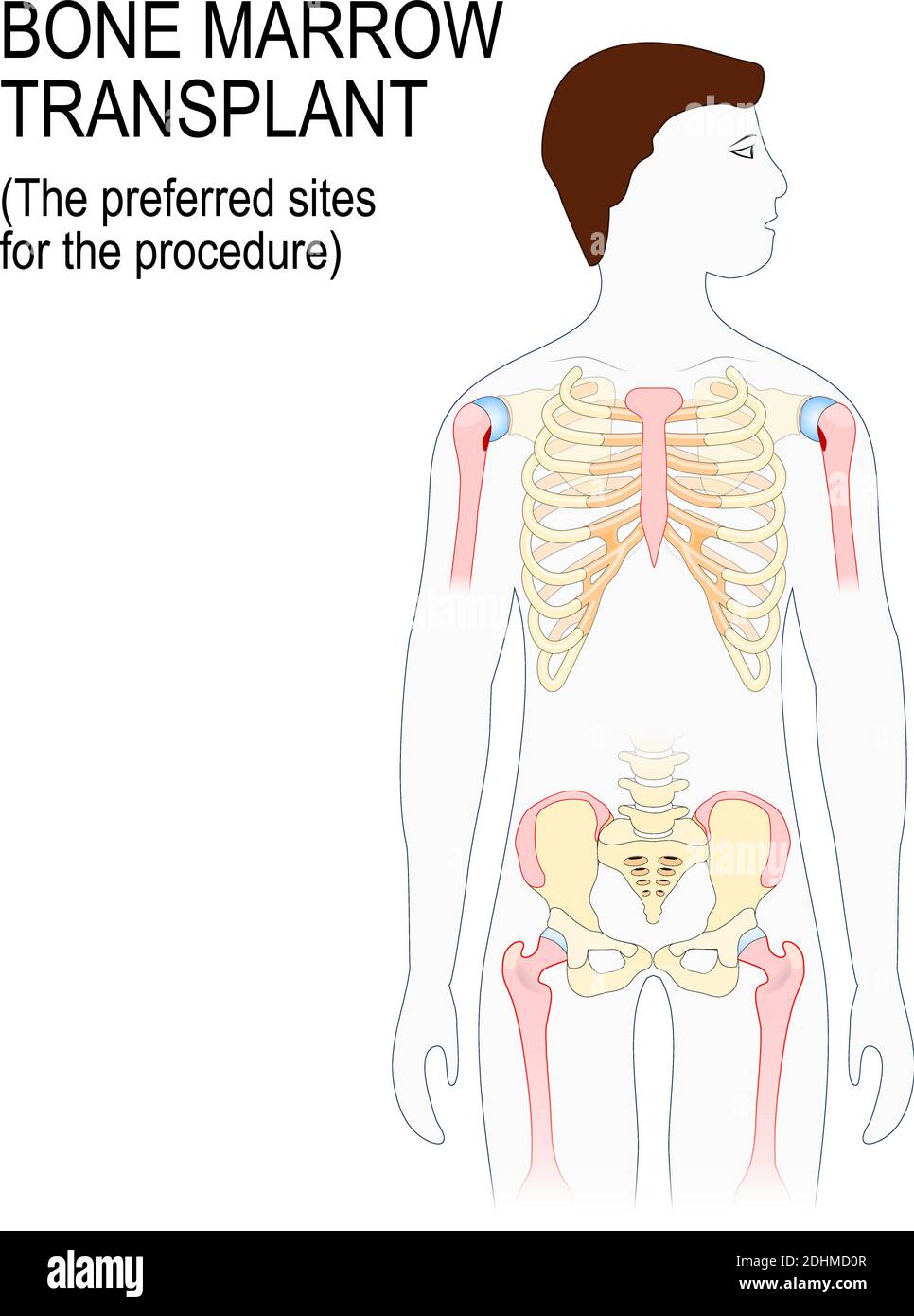 bone marrow transplant. The preferred sites for the transplantation procedure (Sternum, iliac crest, tibia or femur). man silhouette with highlighted Stock Vector