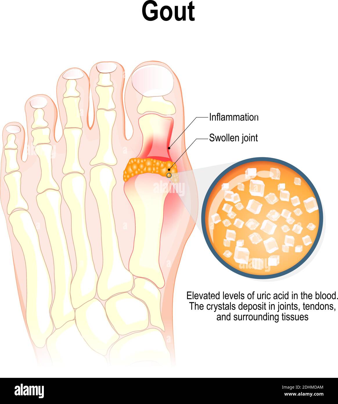 Gout is a form of inflammatory arthritis. Characterized by elevated levels of uric acid in the blood. This uric acid crystallizes Stock Vector