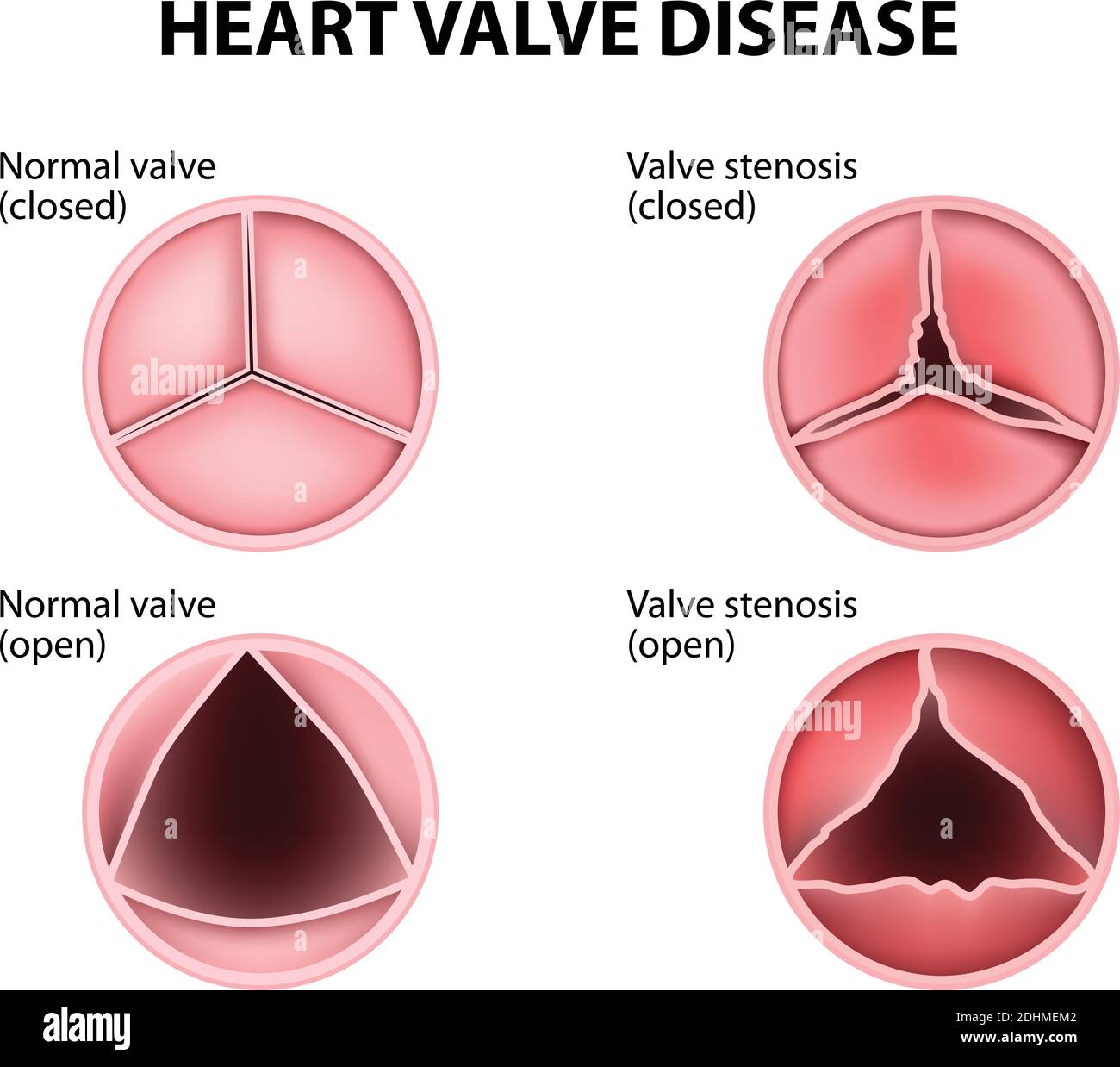 Valvular heart disease Stock Vector