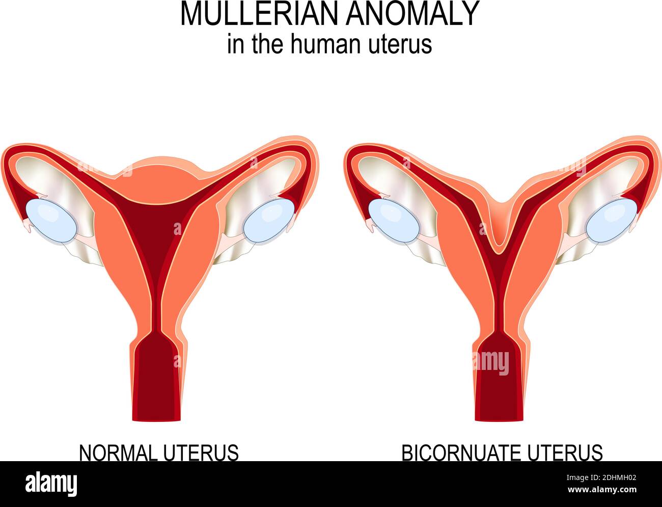 Mullerian anomaly In the human uterus. Normal womb and Bicornuate uterus. Vector illustration for medical, biological, educational and science use Stock Vector