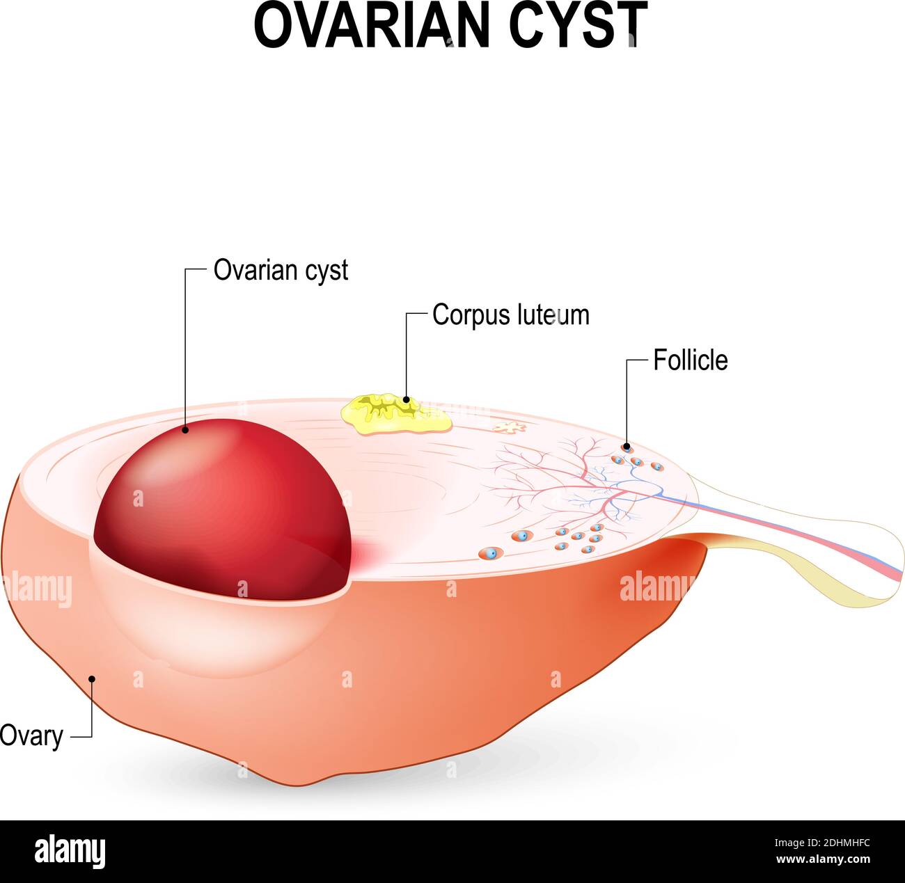 Ovarian cyst. A fluid-filled sac in the ovary. Stock Vector