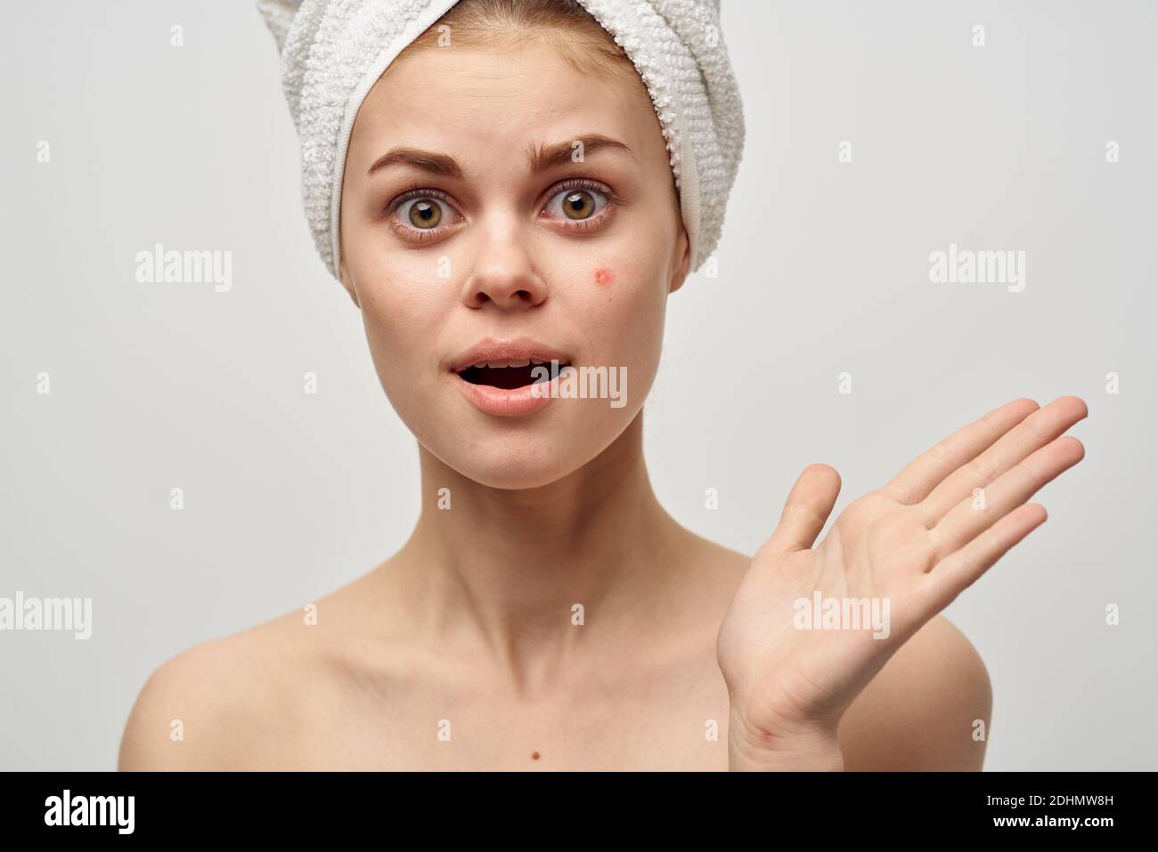 women in a towel and with pimples on their face gesturing with their hands clean skin acne Stock