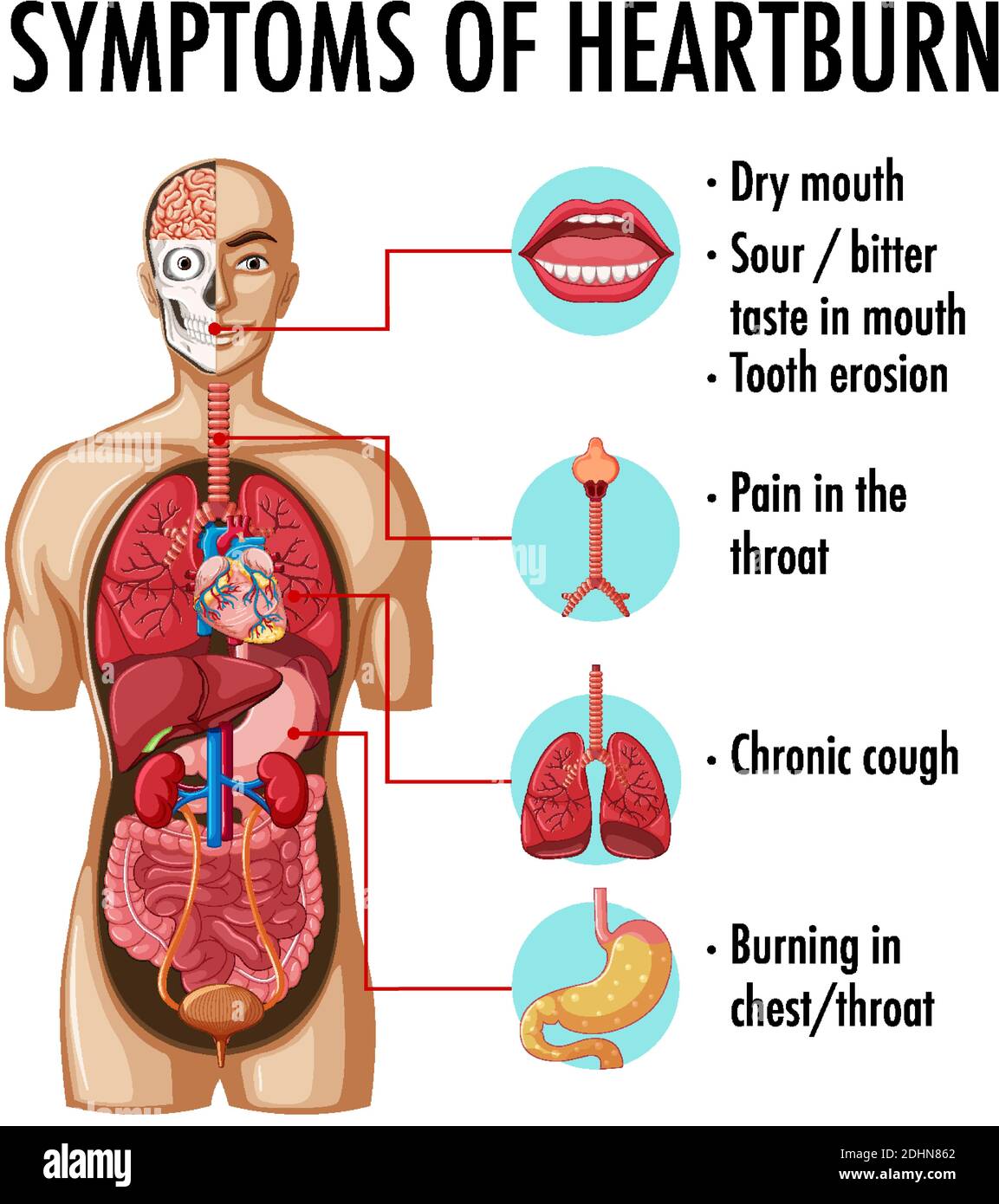 Symptoms of heartburn information infographic illustration Stock Vector