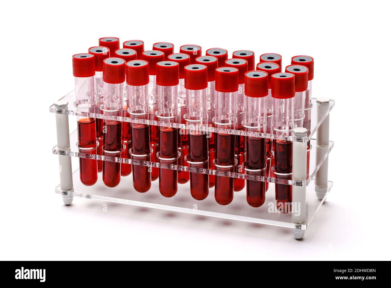 A rack of vacuum venipuncture test tubes filled with blood samples