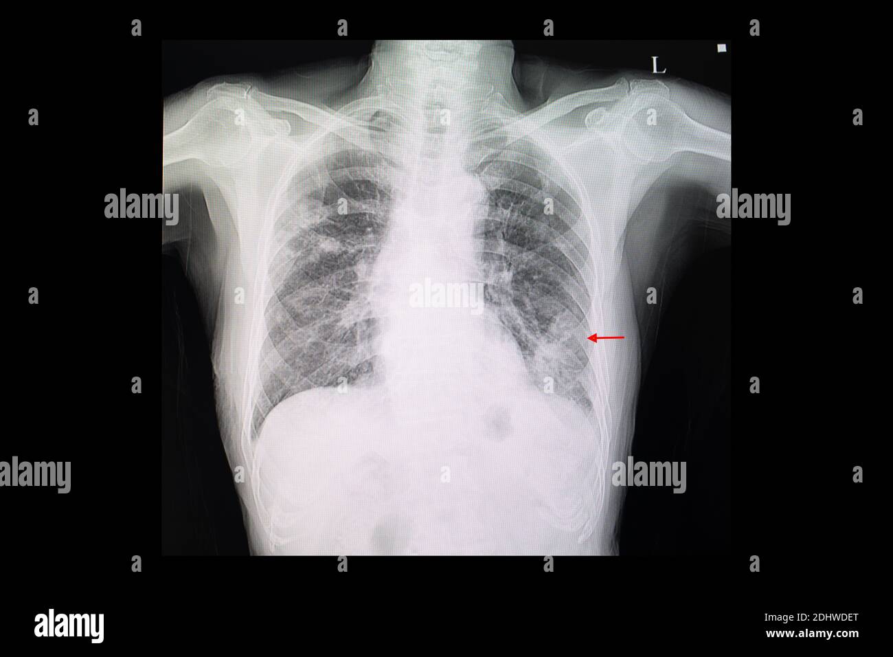 A chest x-ray film of a patient with left lower lung pneumonia and right upper lung nodules Stock Photo