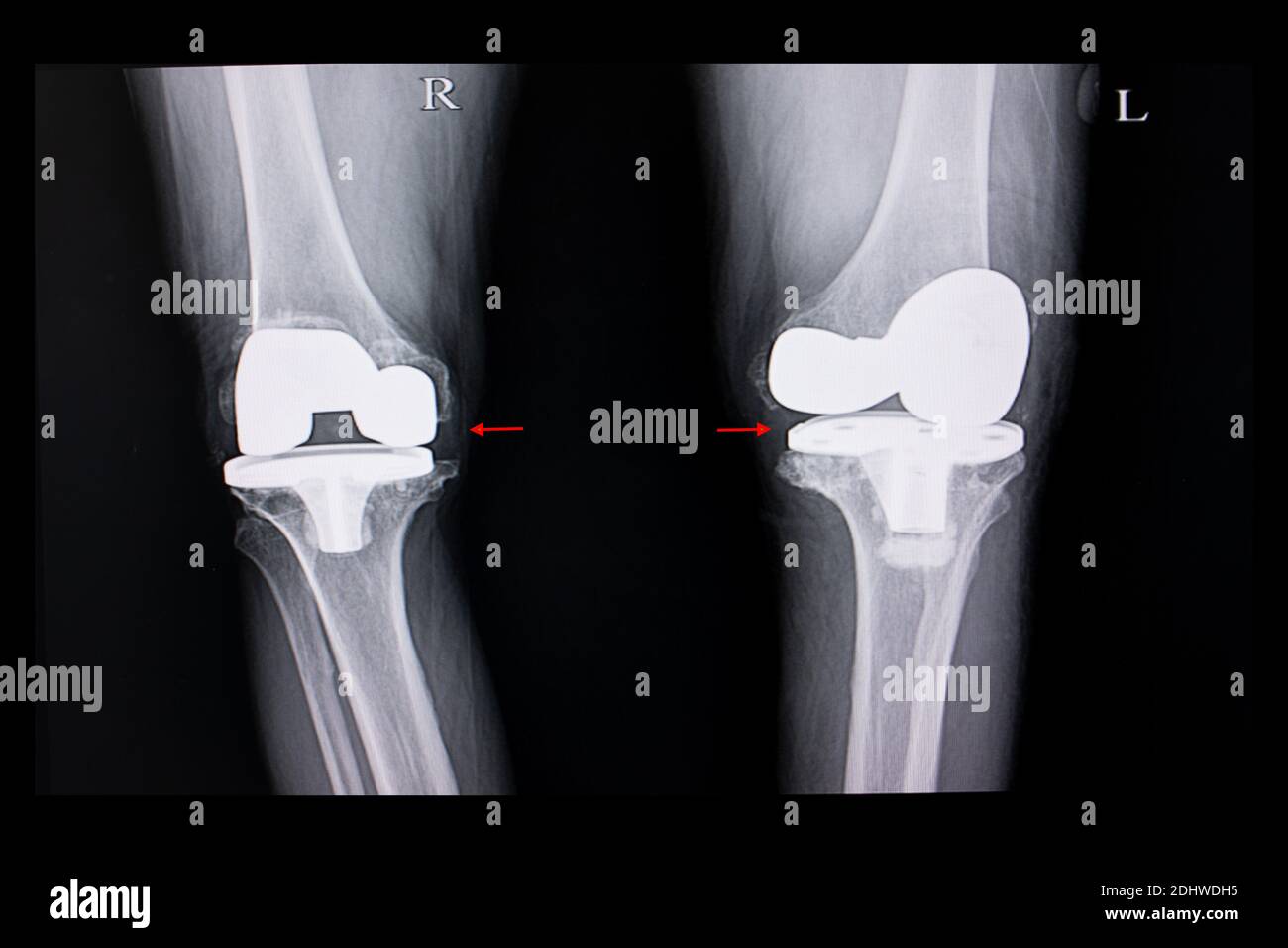 Xray film of a patient with both knees arthroplasty operation. Stock Photo