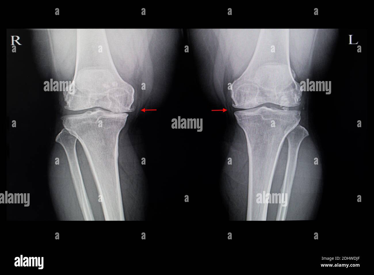 Xray film of a patient with both knees degenerative osteoarhthritis