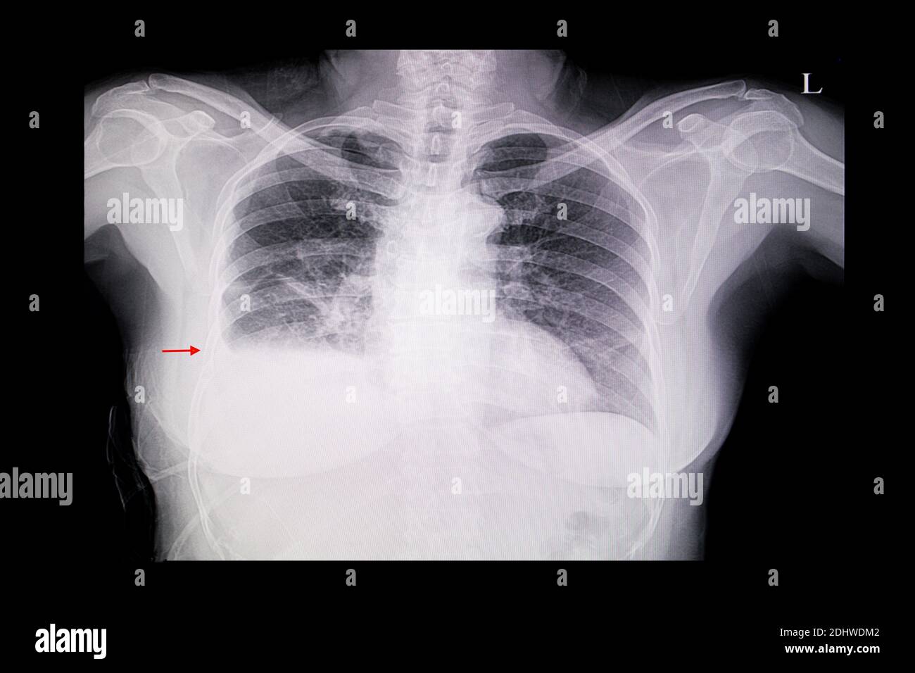 A chest x-ray film of a female patient with cardiomegaly, pulmonary edema and right lung pleural effusion. Stock Photo
