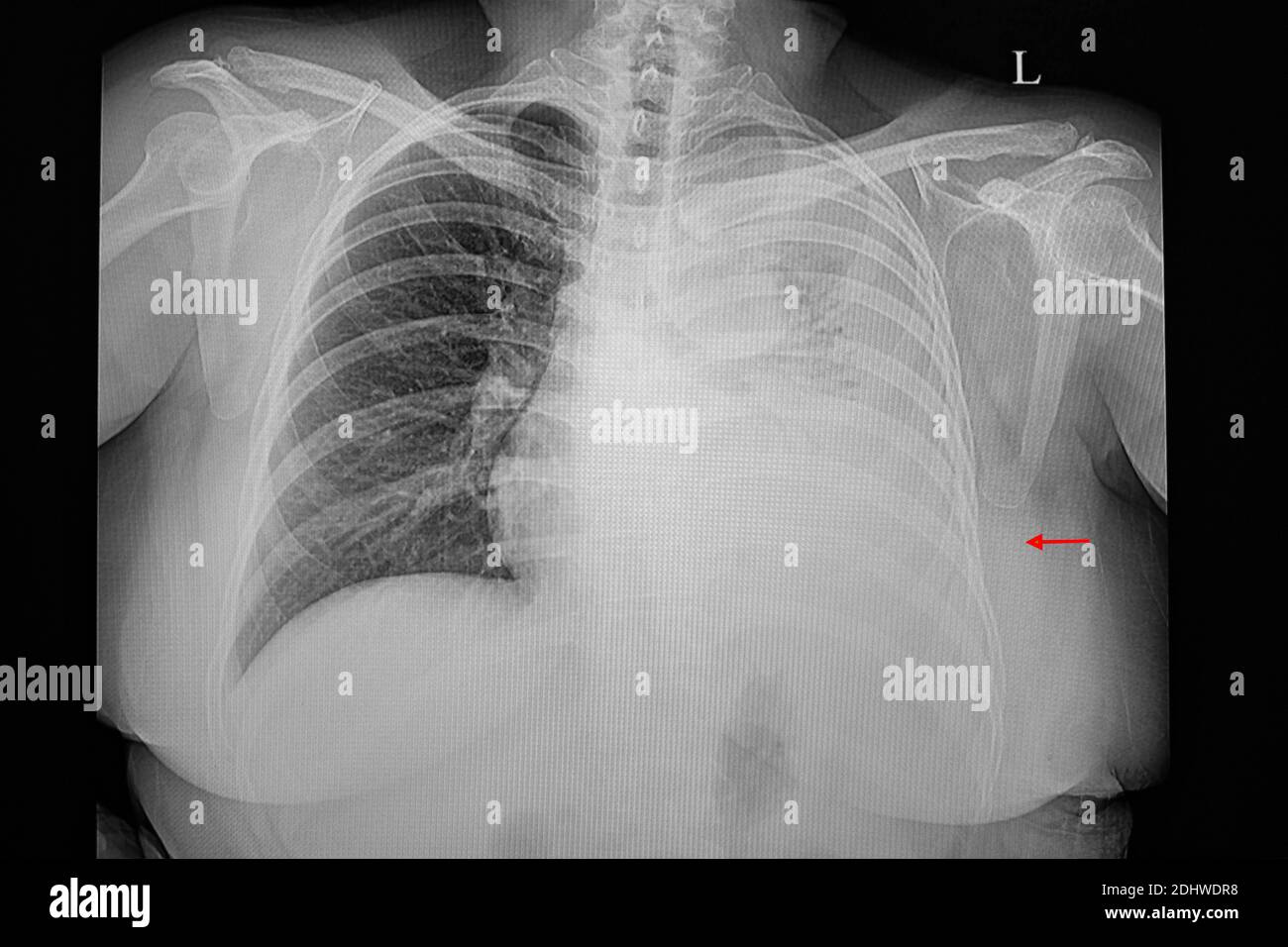 A chest xray film of a patient with massive pleural effusion. Fluid in