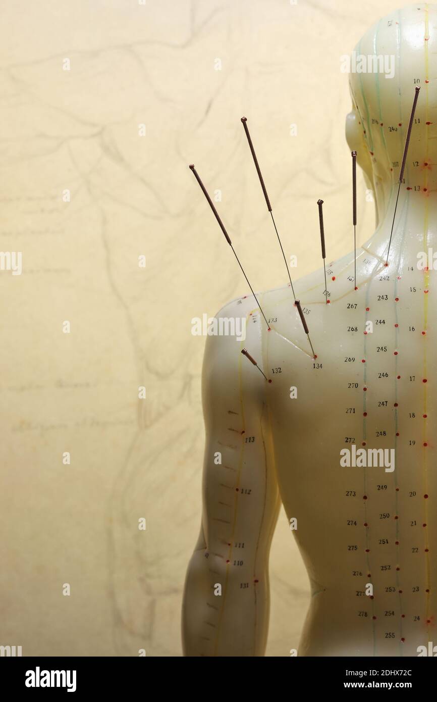 male acupuncture model with needles in the left shoulder Stock Photo