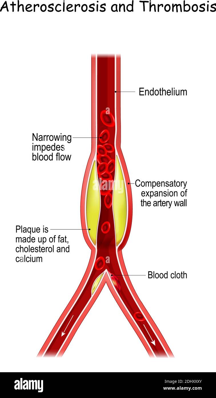 Atherosclerosis and Thrombosis. Thrombus formation in an atherosclerotic vessel. The rupture of an atherosclerotic plaque is start of thrombosis. Stock Vector