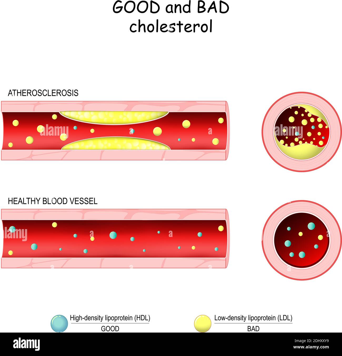good (HDL) and bad (LDL) cholesterol. Healthy blood vessel and Atherosclerosis. Cross section of blood vessel. Low-density, High-density lipoprotein Stock Vector