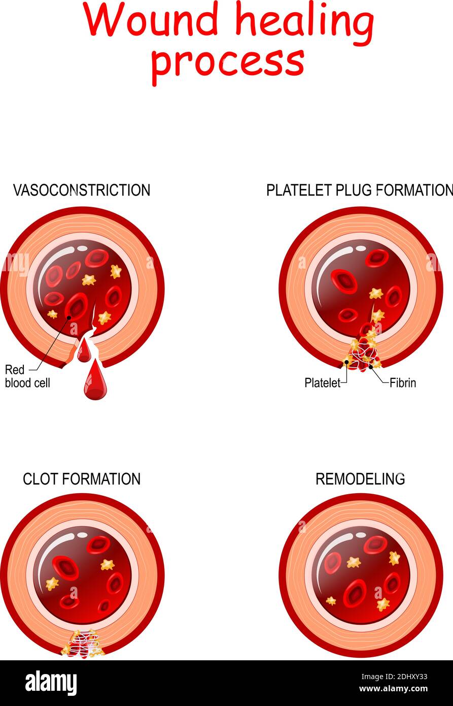 Phases of the wound healing process. Hemostasis, Inflammatory, Proliferative, Maturation and remodeling phase. Cross section of blood vessel. poster Stock Vector