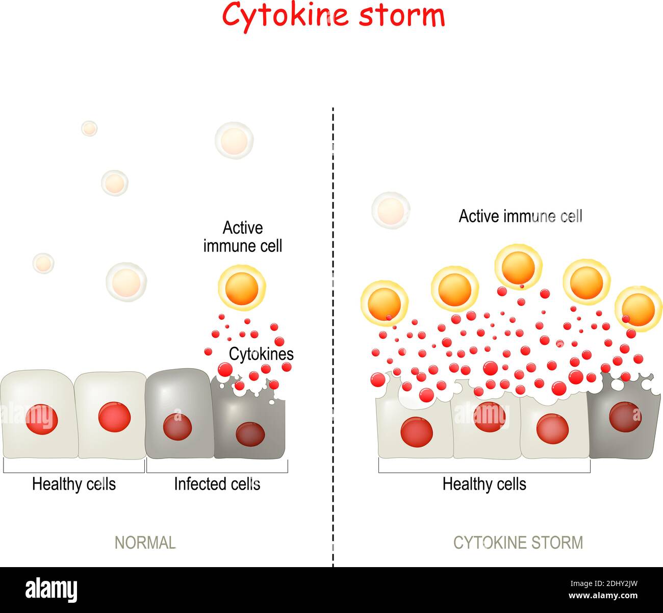 cytokine storm or hypercytokinemia. COVID-19 complications. physiological reaction in which the innate immune system causes an uncontrolled Stock Vector