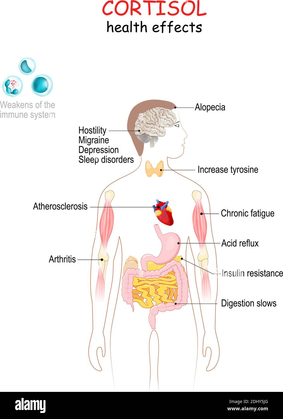 Cortisol health effects. Human's body with internal organs affected by cortisol. Decreases of metabolism, Insulin resistance, Digestion slows Stock Vector