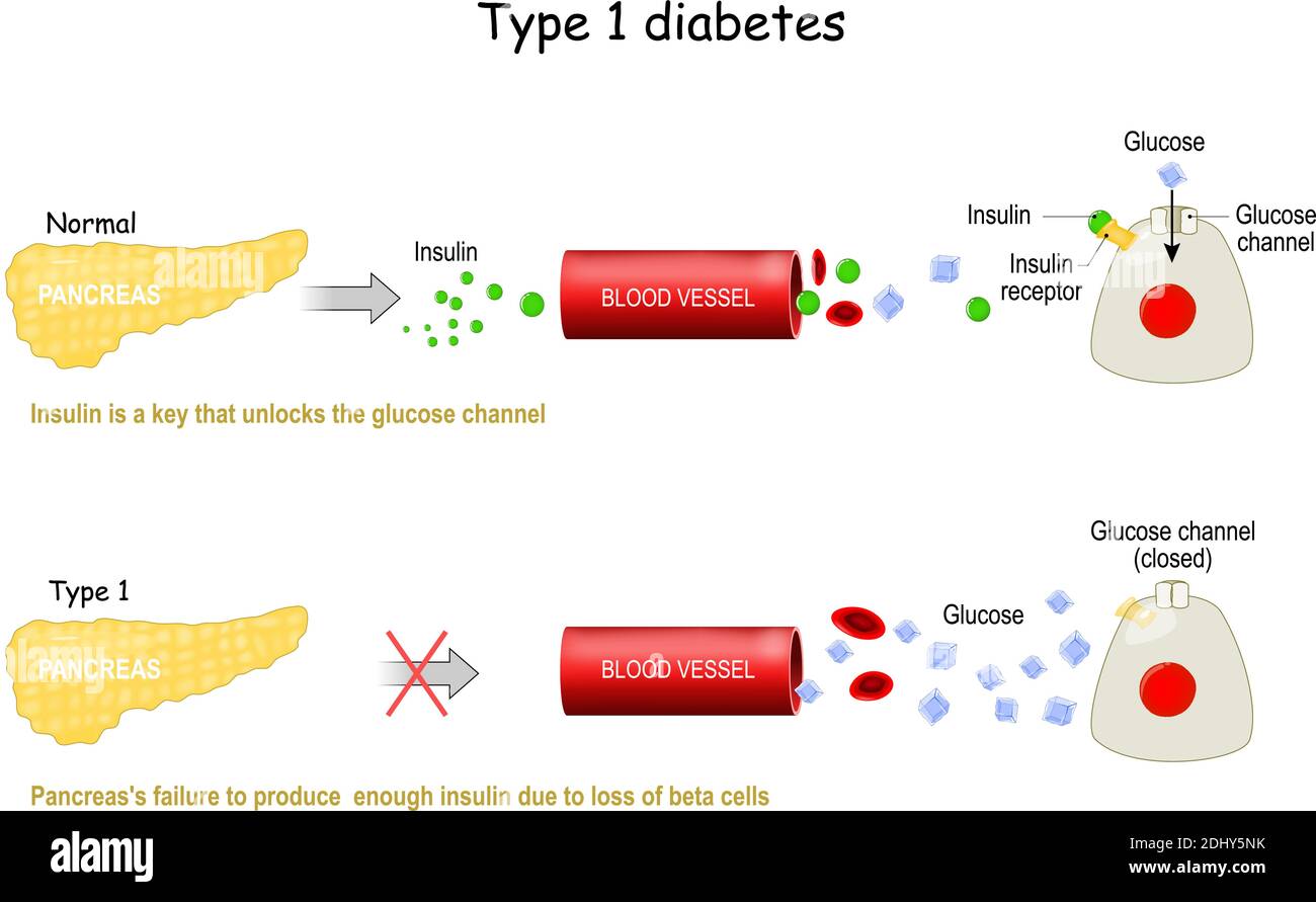 Types 1 of Diabetes Mellitus. Pancreas's failure to produce  enough insulin due to loss of beta cells Stock Vector