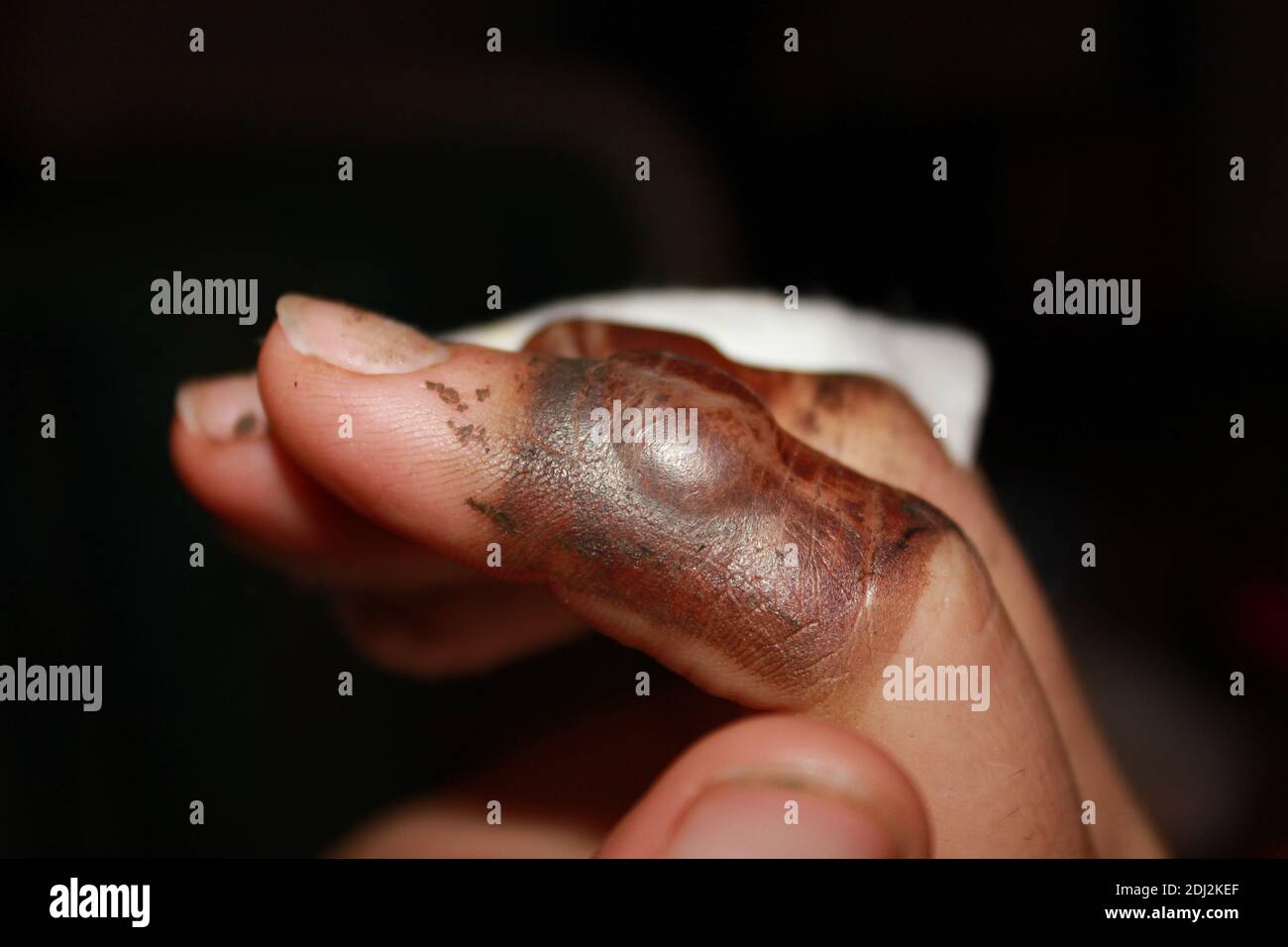 burned fingers with big blisters Stock Photo