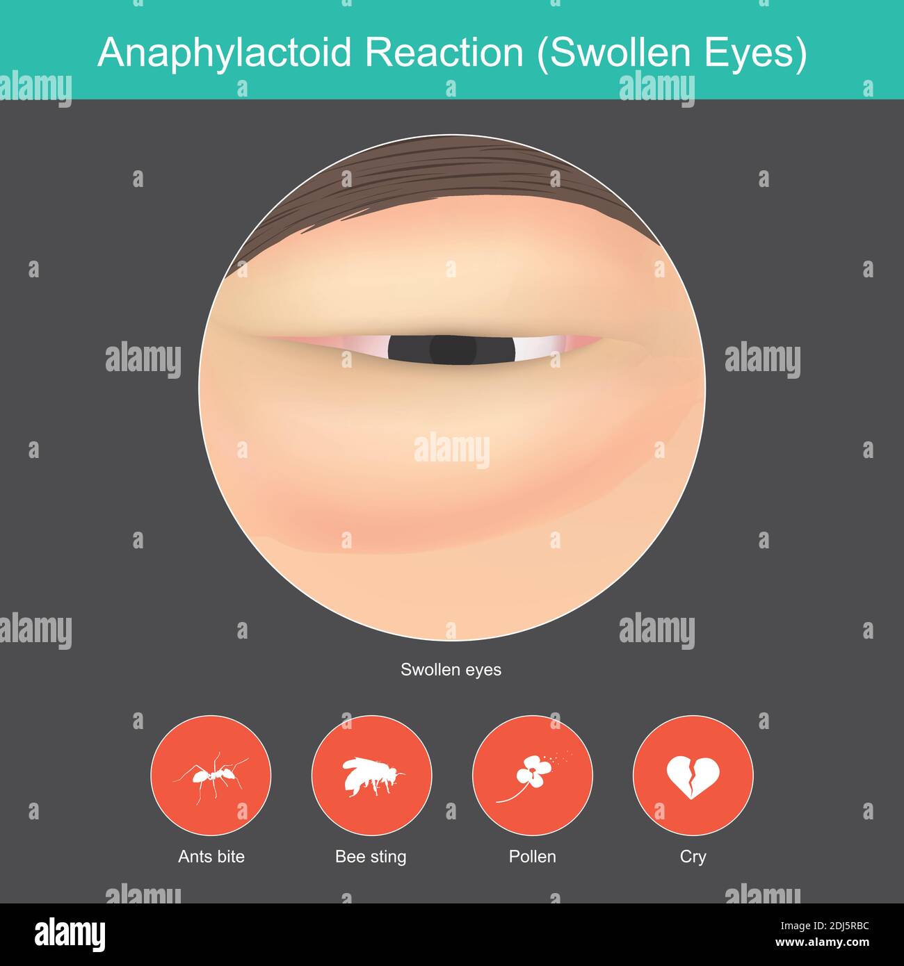 Anaphylactoid Reaction. Illustration show close up around the eye from a symptoms in reaction the immune system response. Stock Vector