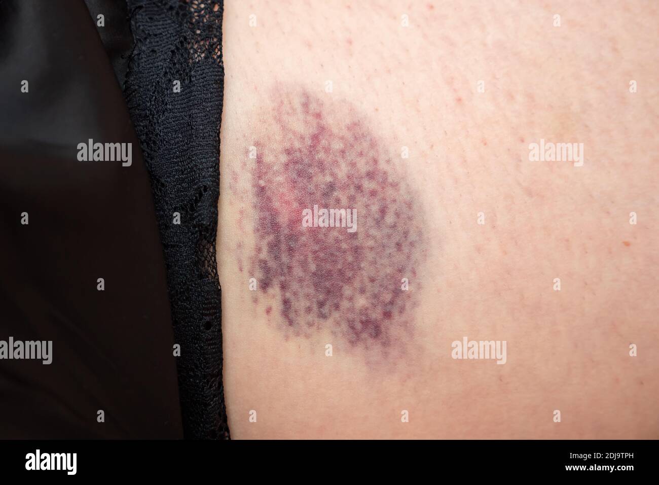 blue and pink bruise on female thigh close-up Stock Photo