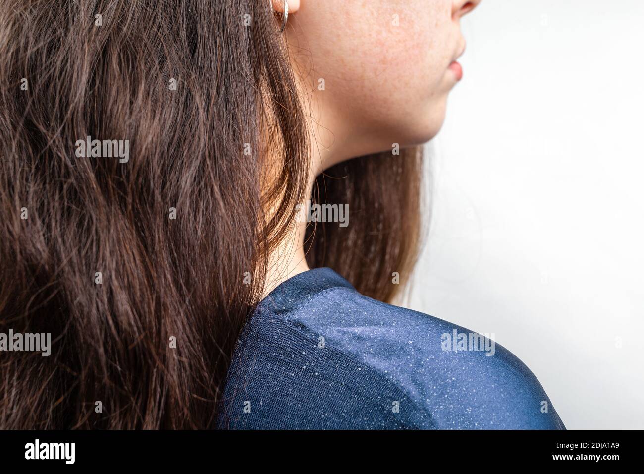 A close-up of a woman's shoulder showing dandruff. Dark female hair. White background. The concept of dandruff and pediculosis. Stock Photo