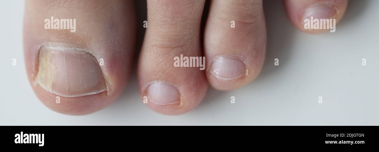 Yellow nail toenail polish hi-res stock photography and images - Alamy Yellow nail toenail polish hi-res stock photography and images - Alamy