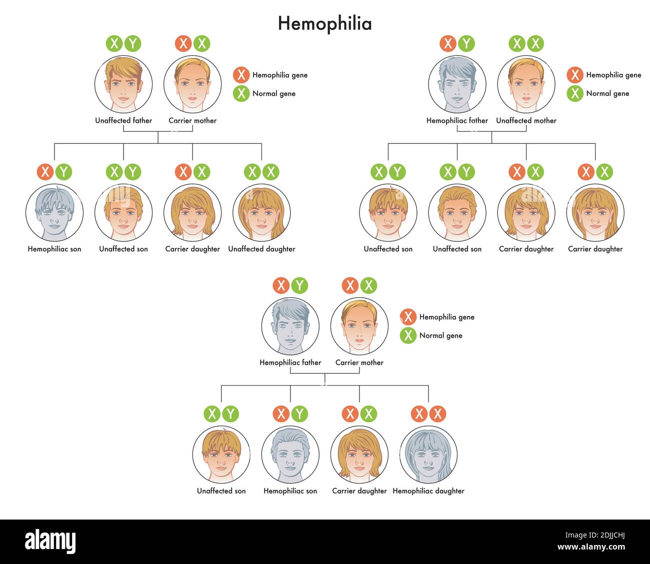 Hemophilia is the consequence of a genetic alteration of the X chromosome transmitted from parents to children. Stock Vector