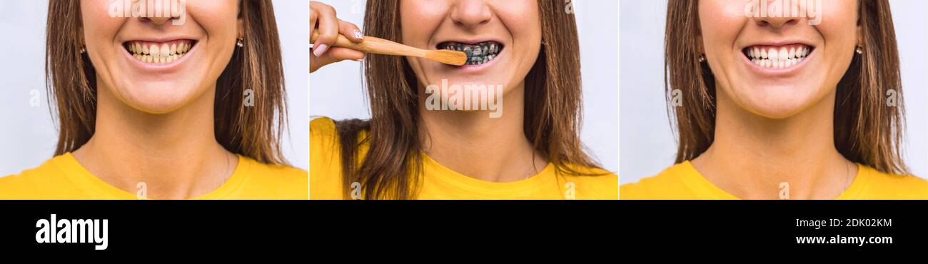 Yellow and white teeth before and after. Black charcoal whitening toothpaste. Stock Photo