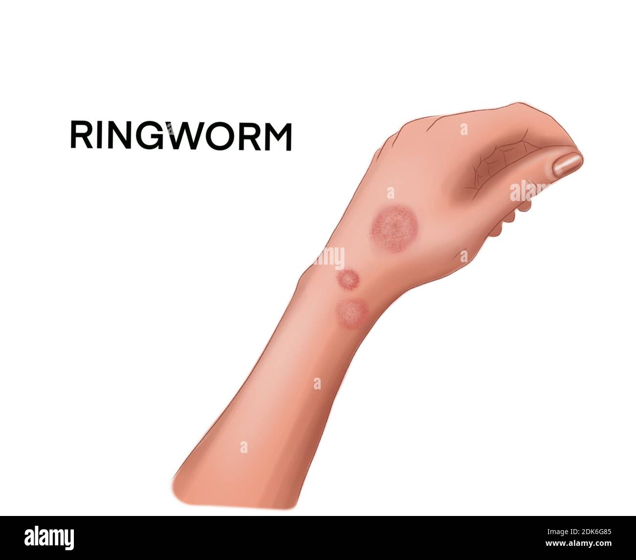 Illustration of the ringworm on the hand Stock Photo