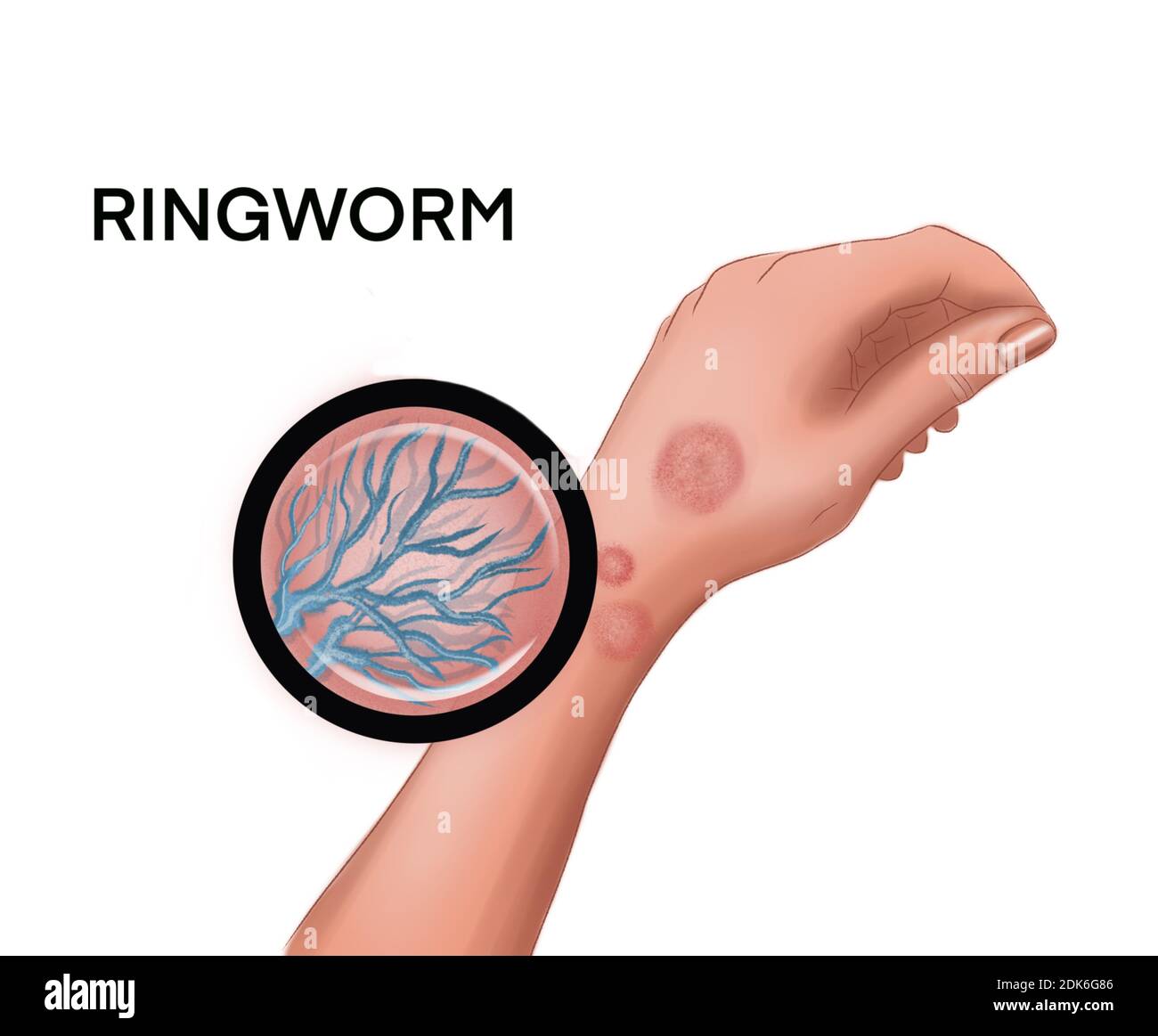 Illustration of the ringworm on the hand Stock Photo