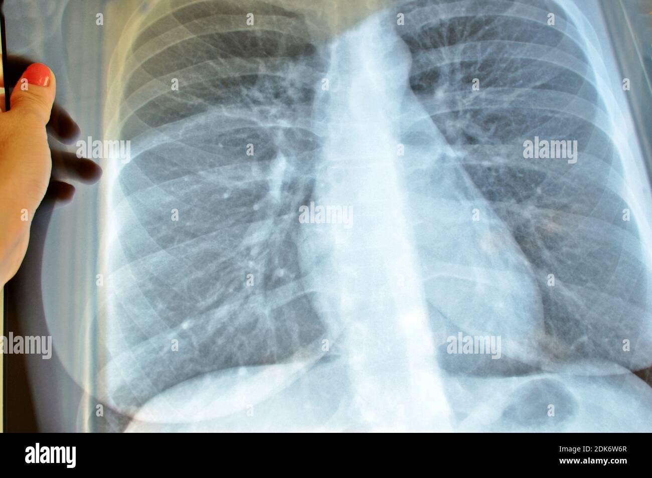 Doctor hands holding a lungs radiography image scan. x-ray film chest or lung of patient for medical diagnose. Pulmonary  medicine exam, science. Stock Photo