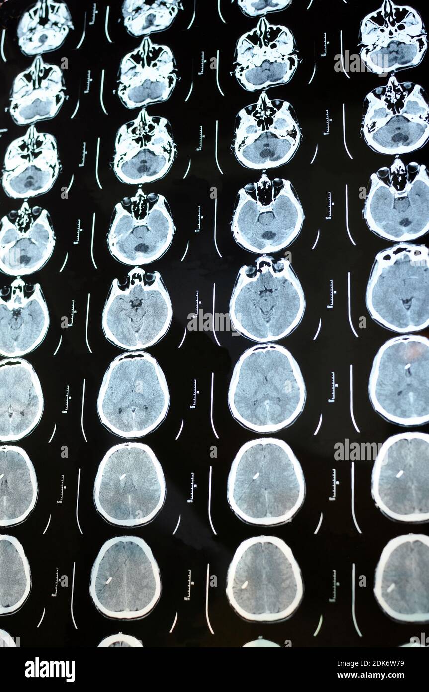 Computed tomography image scan of the brain. CT film of a human skull and brain with intracranial shunt. Neurology background. Medicine, science, vert Stock Photo