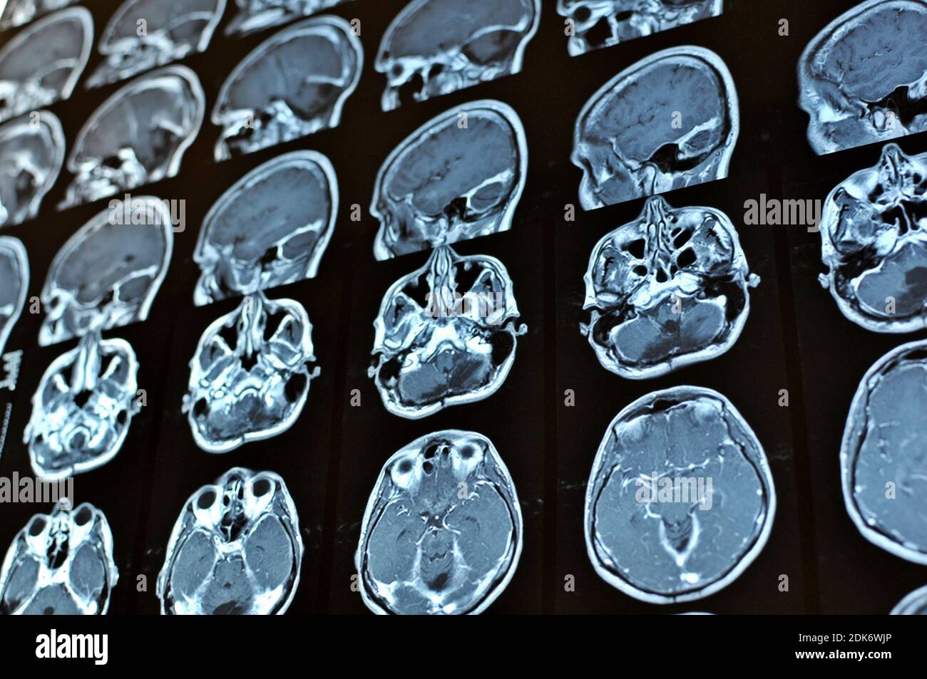 Magnetic resonance image scan of a man brain with a colloid cyst. MRI film of a human skull and brain tumor. Neurology background. Medicine, science. Stock Photo