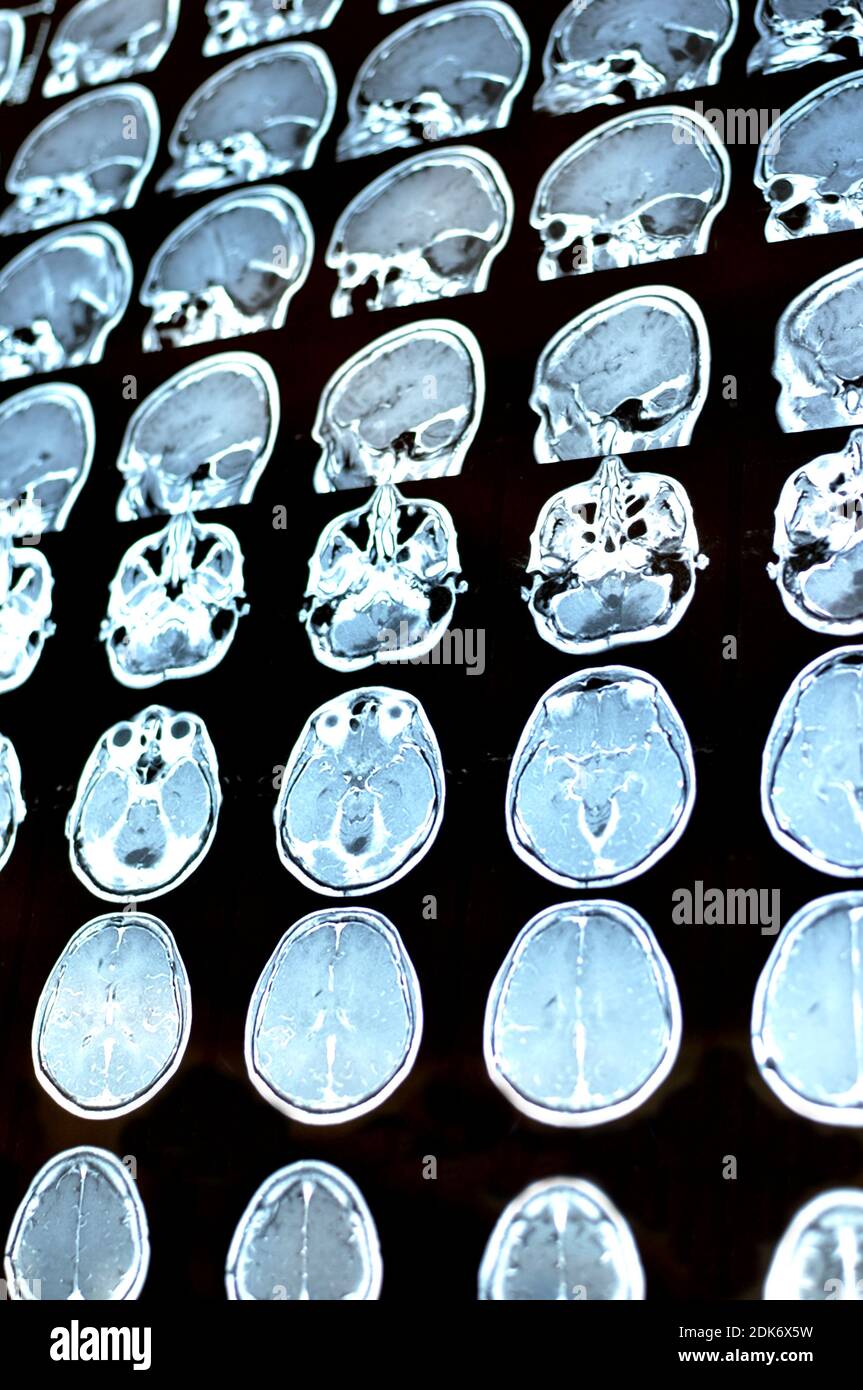 Magnetic resonance image scan of the brain with a colloid cyst. MRI film of a human skull and brain tumor. Neurology background. Medicine, science Stock Photo