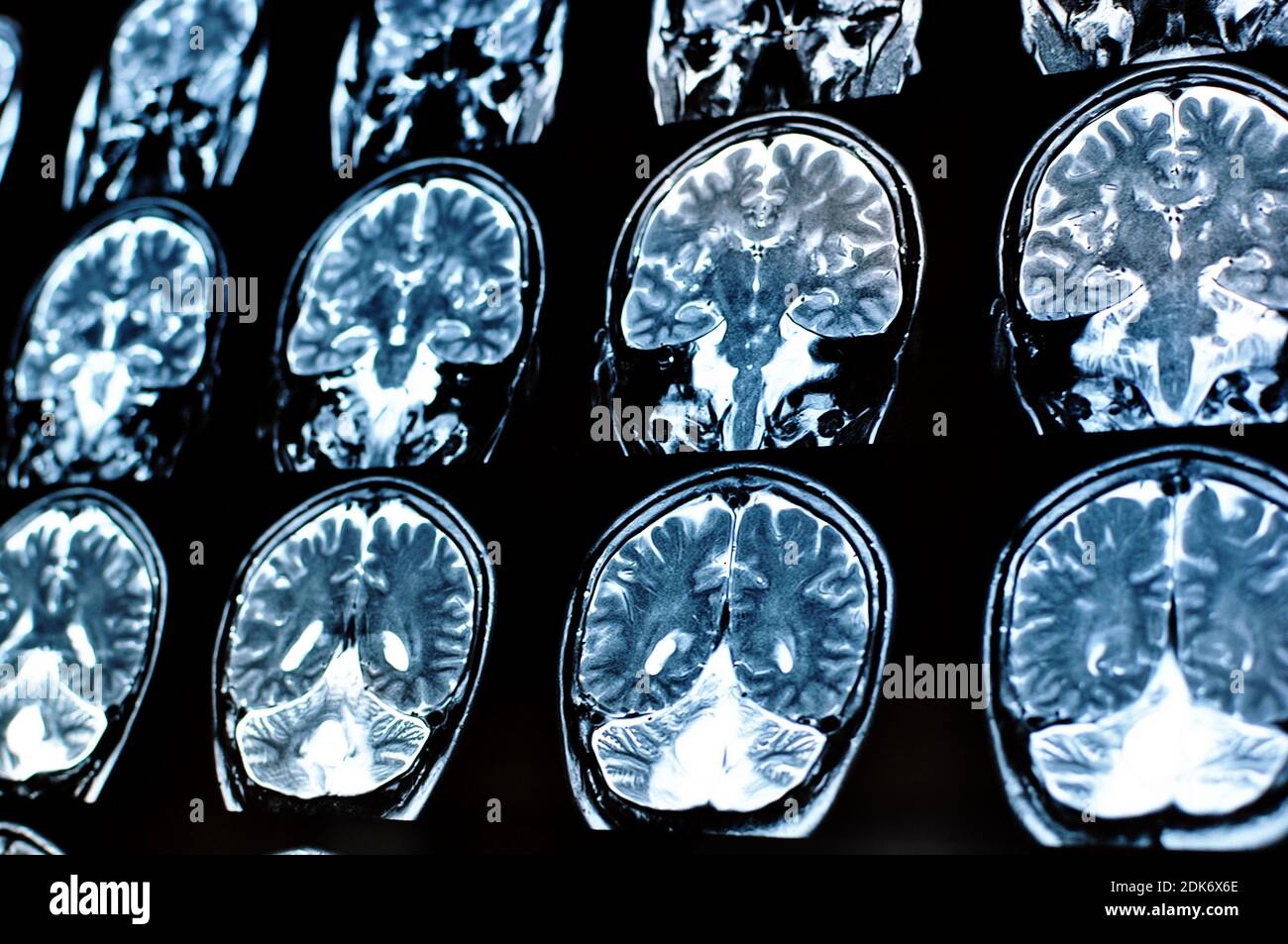 Magnetic resonance image scan of a man brain with a colloid cyst. MRI film of a human skull and brain tumor. Neurology background. Medicine, science. Stock Photo