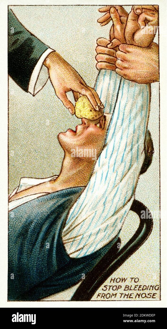 Antique cigarettes cards. Wills's Cigarettes (series First Aid ). How to Stop a Nose Bleed, England. 1913 Stock Photo
